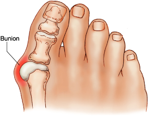 Bunions Hard Skin