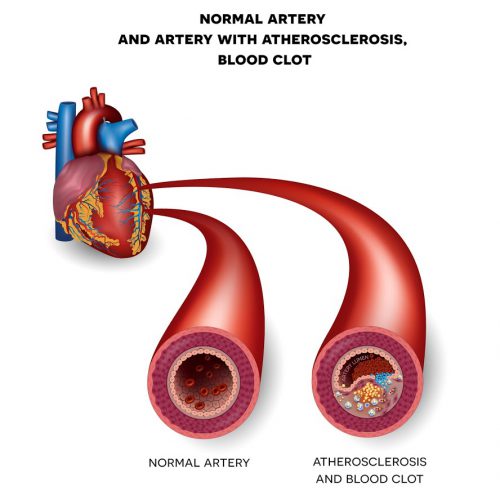 photo Real Pictures Of Clogged Arteries cardiac screen
