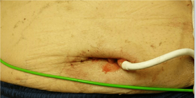 LVAD Drive Line Infection