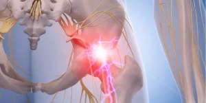 Medical illustration of a sciatic pinched nerve