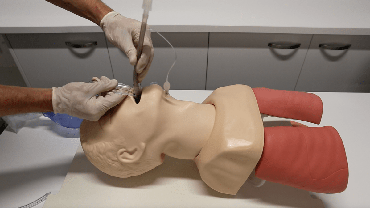Blind nasotracheal intubation (nti) is an alternative to fiberoptic endoscopy. Plan B - Critical Care Airway ManagementCritical Care