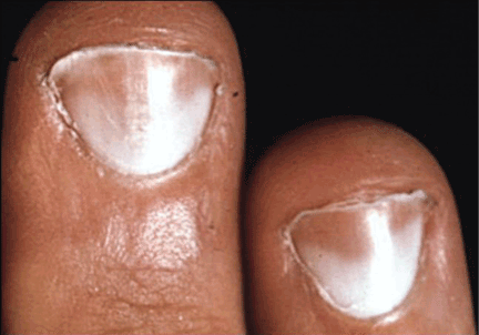 What Do The Vertical Lines On My Nails Mean Futurederm