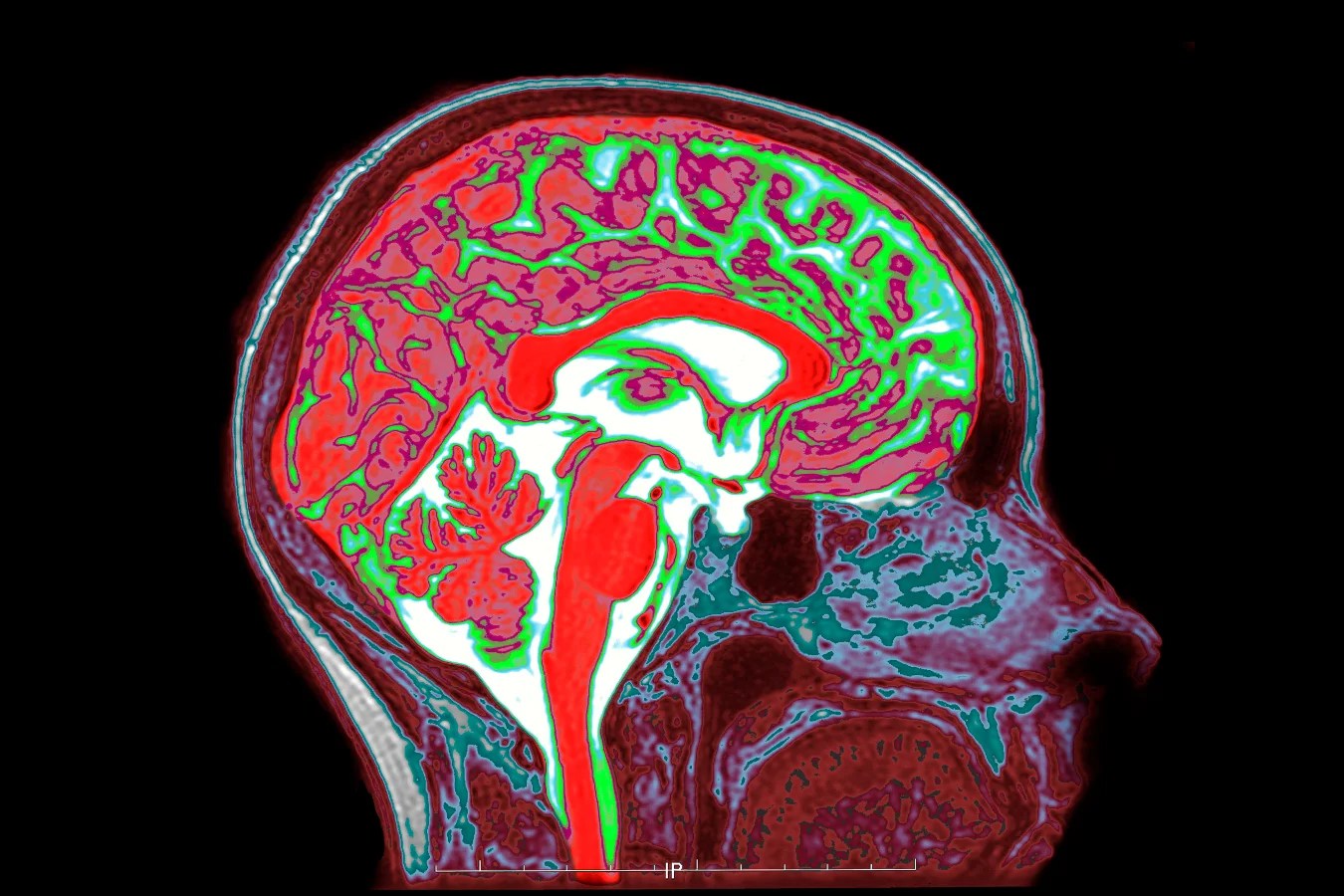 El cerebro envejece de cinco maneras