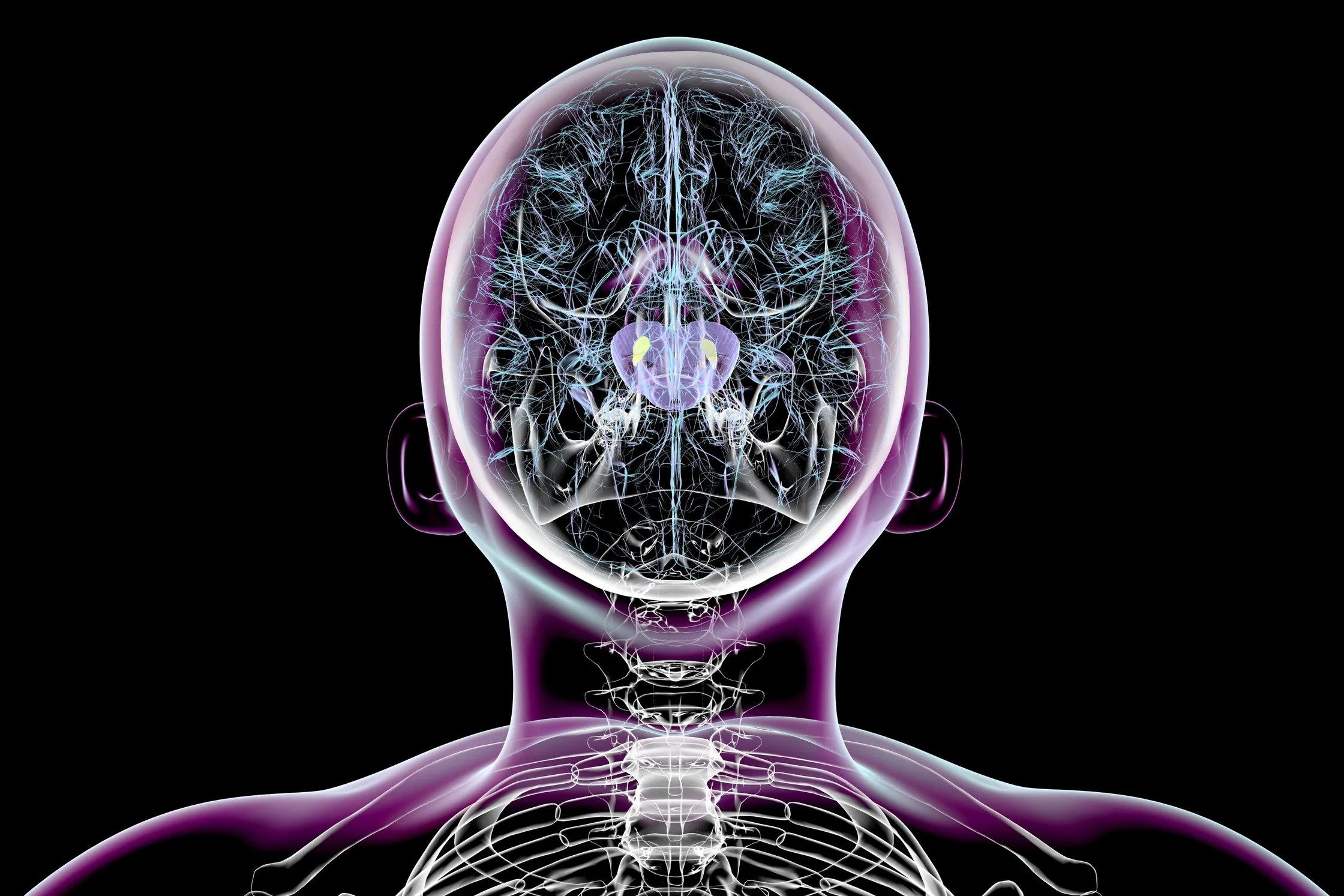 Ilustración del cerebro humano que muestra una sustancia negra encogida, una degeneración propia de la enfermedad de Parkinson.