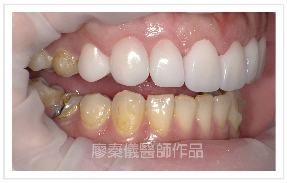 3d齒雕缺點3d齒雕小學堂 這些缺點不可以忽略 Lousi Imagine