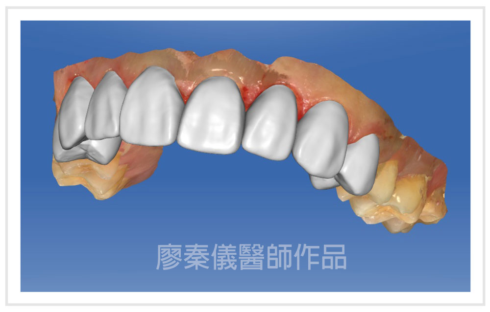 齒雕cerec Lyins
