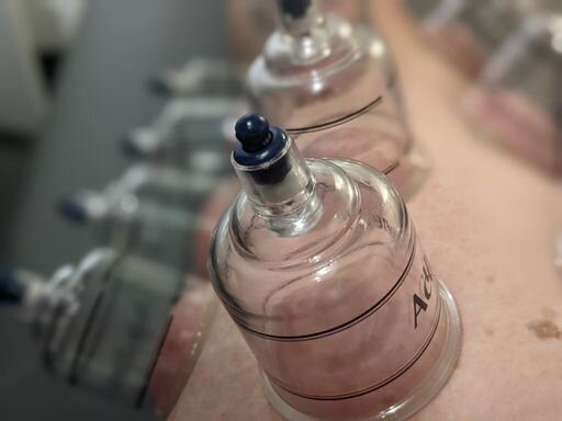Cupping Therapy at ClareMotion Physical Therapy in Washington, D.C.