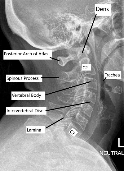 It's commonly done after someone has been in an automobile or other accident. Anatomy Of The Spine Complete Orthopedics Multiple Ny Locations