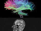 Multiple Sclerosis Ms Models Creative Bioarray Creative Bioarray