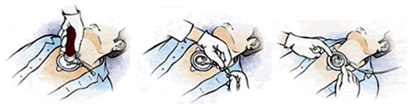 Diagram showing how to use the F.A.S.T.1