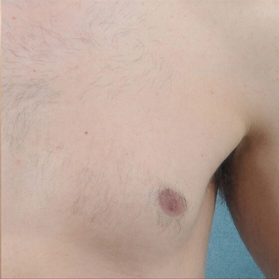 High Volume Hair Removal Vectus Laser Cynosure