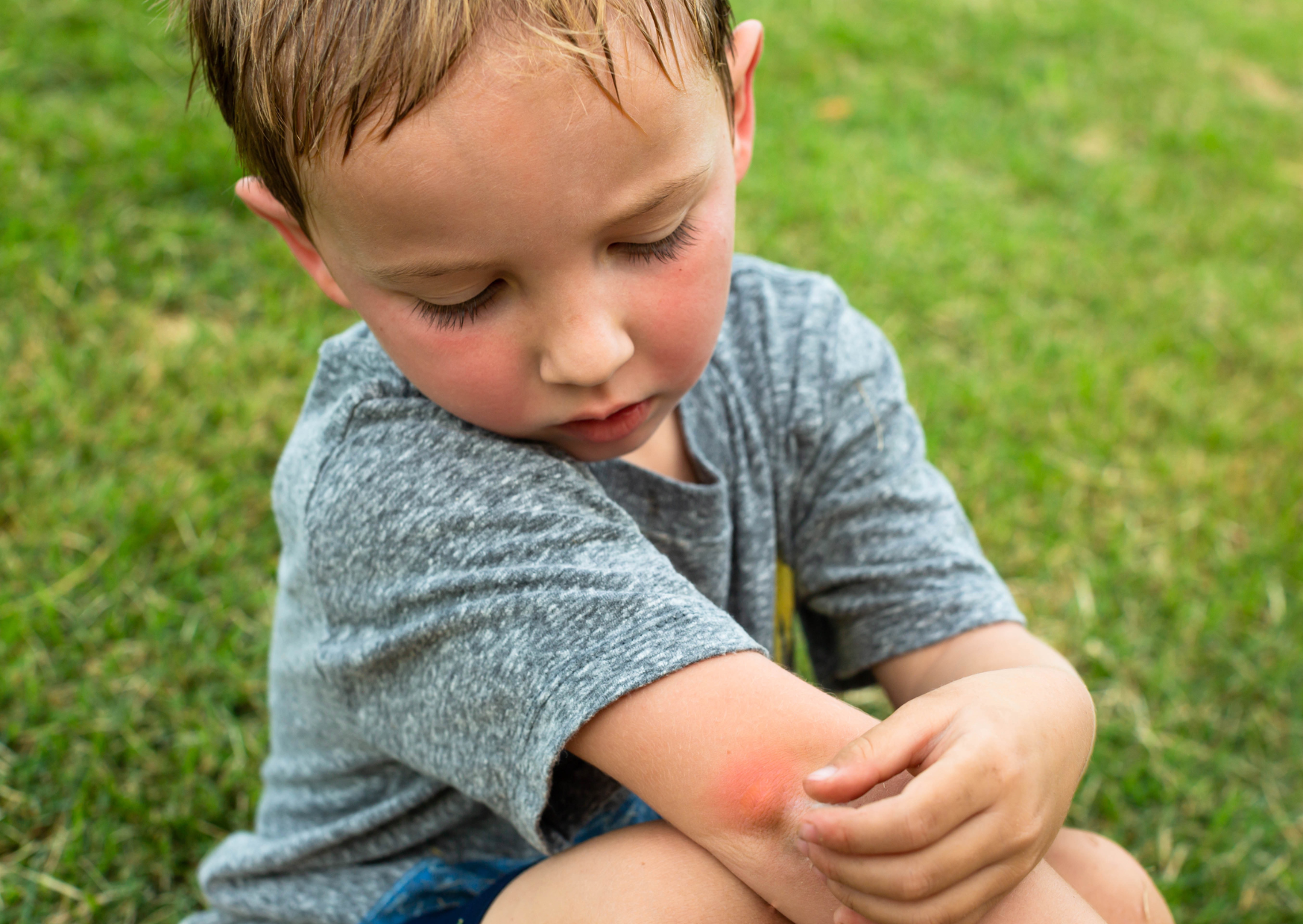 Insect Bites Wecare