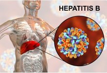 HEPATITIS