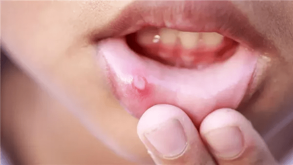 تقنية جديدة تحيّد فيروس الهربس وتفتح آفاق الوقاية