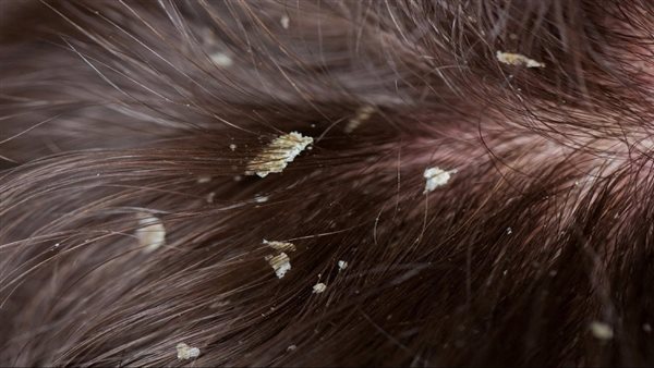 سبب خفي وراء قشرة الرأس المزعجة