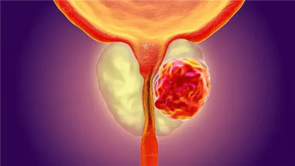 استراتيجية مبتكرة لعلاج سرطان البروستات في مراحله الأولى استراتيجية مبتكرة لعلاج سرطان البروستات في مراحله الأولى