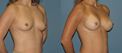 Breast Augmentation Dallas TX