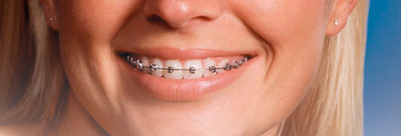Die kosten für kunststofffüllungen werden von der gesetzlichen krankenkasse nicht vollständig übernommen. Feste Zahnspange - Mini-Brackets - Keramik-Brackets