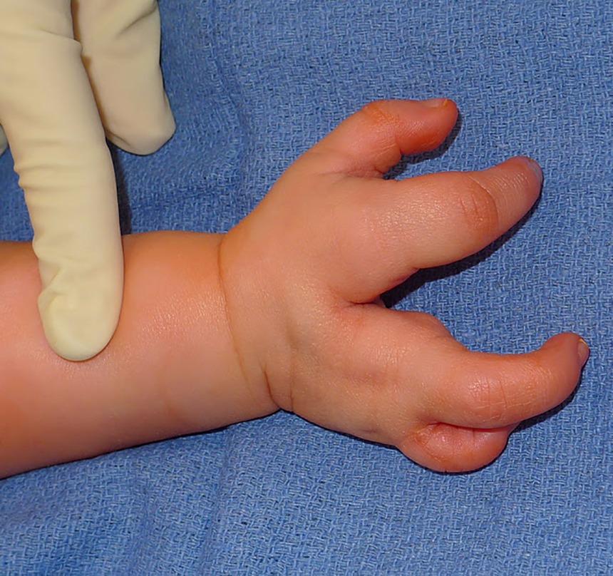 hand-congenital-dr-adash