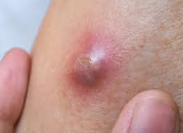 Homeopathic Medicine for Boils