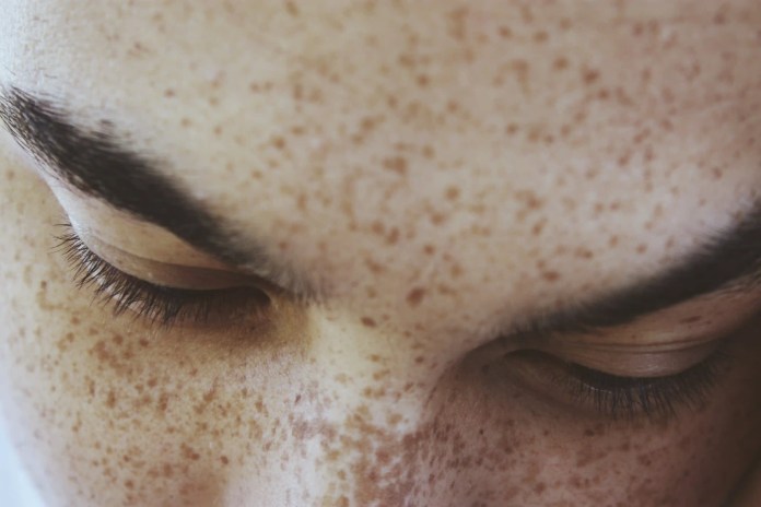 Homeopathic Medicine for Black Spots on Face