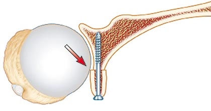 Laterjet Labral Repair