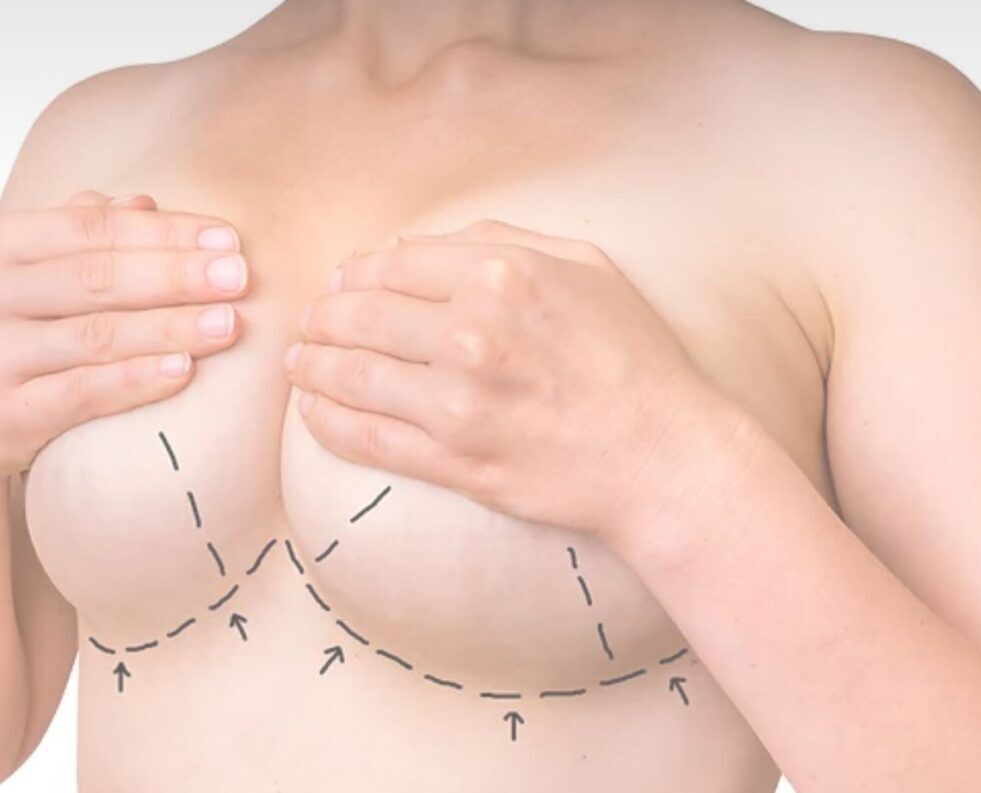 Breast Reduction e1707037182131