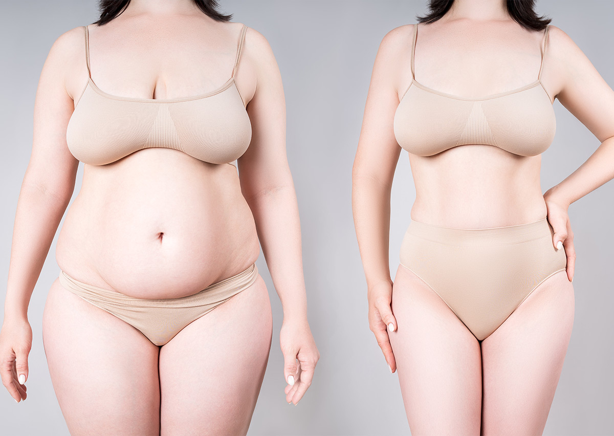 abdominoplasty
