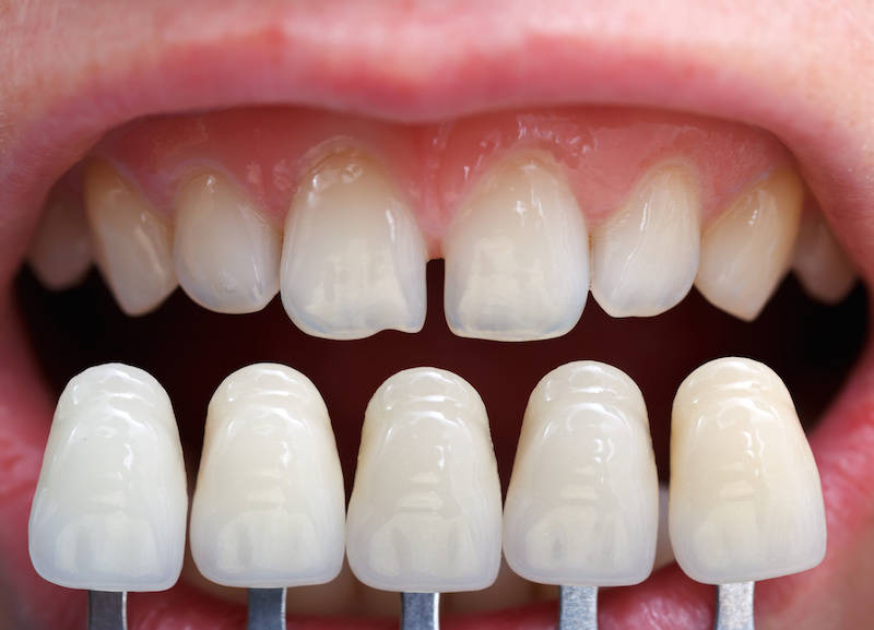 5 Dental Procedures To Repair Your Cracked Or Broken Tooth