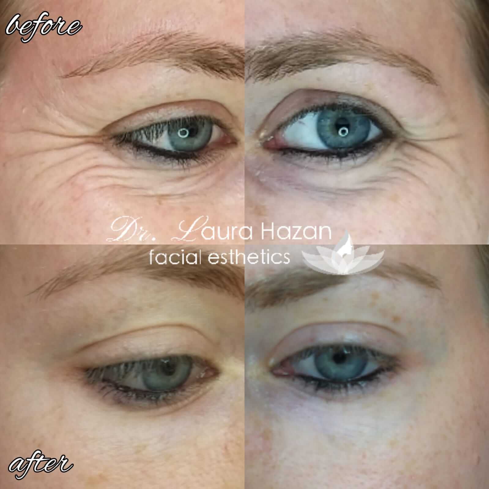 before and after (1)