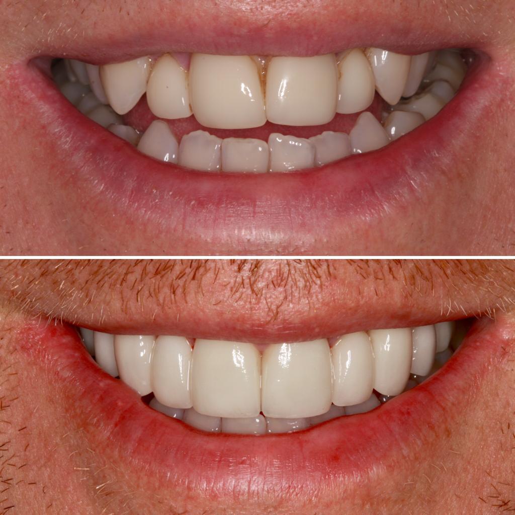 Smile makeover in london