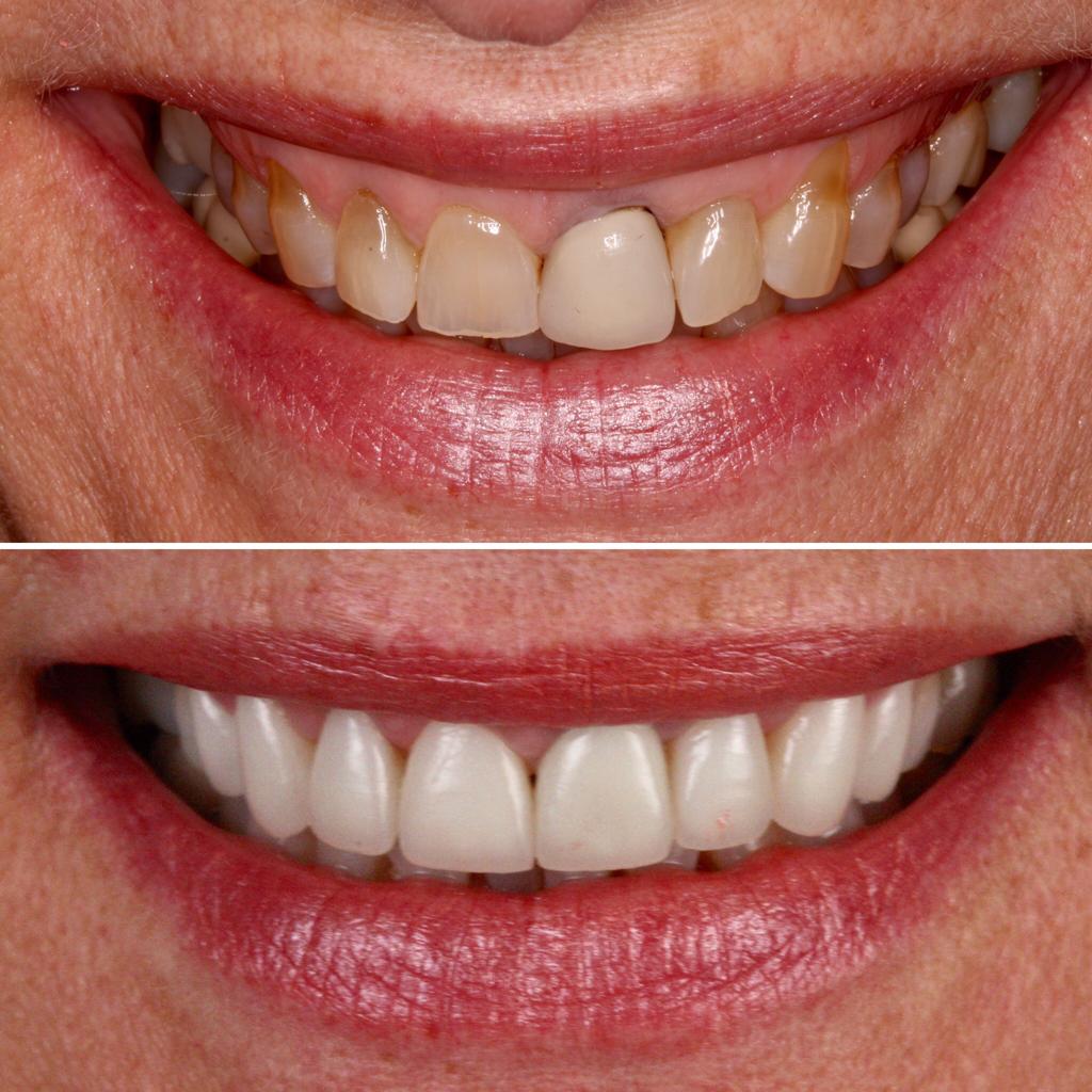 Smile makeover in london