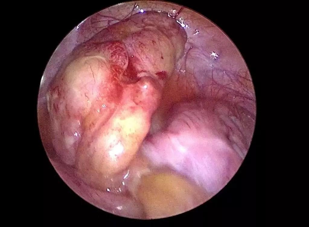 Appendisitis cholelithiasis dr adam kantung empedu penyakit pencernaan. Appendicitis In Children What Is It And How It Can Be Treated In Malaysia