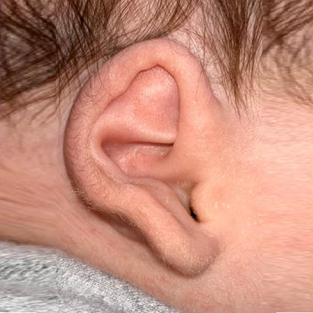 Types of ear deformities