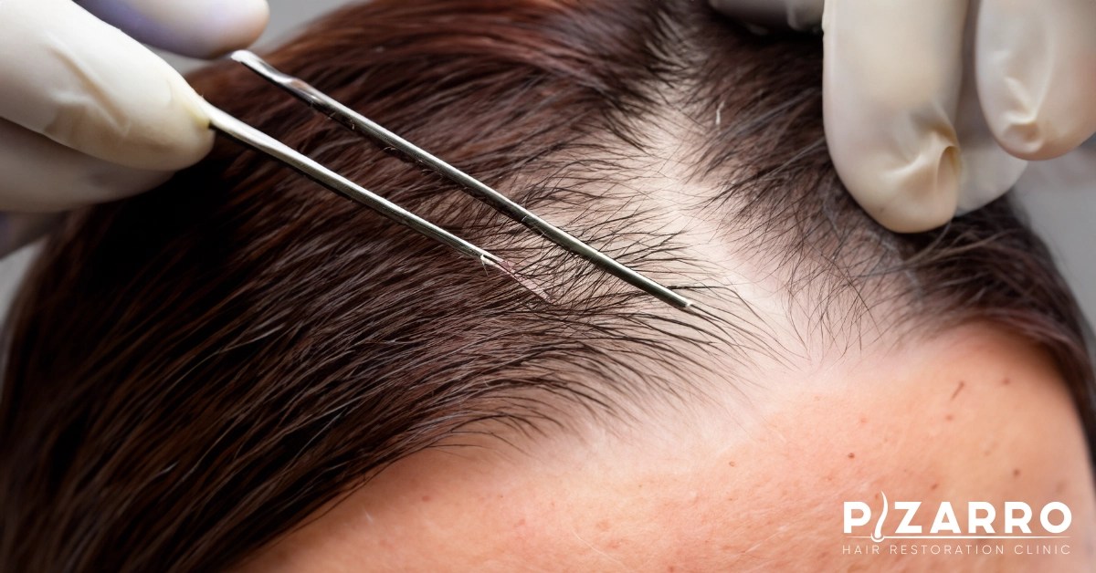 The cost of 5000 hair grafts: what to expect
