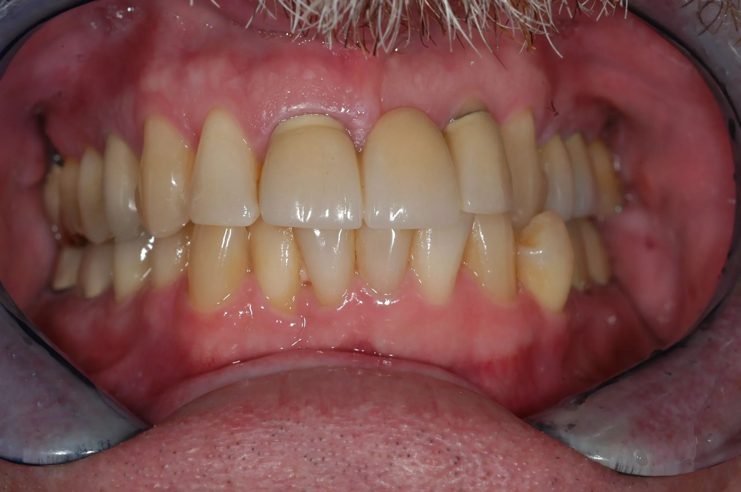 Before