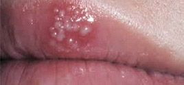 Penyebab utama dari angular cheilitis adalah kombinasi infeksi jamur . Sariawan Di Luar Bibir Tanya Alodokter