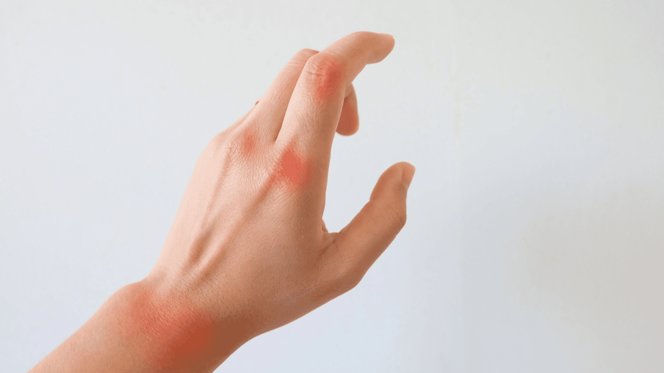 How To Get Rid Of Arthritis In Fingers? DrugsBank