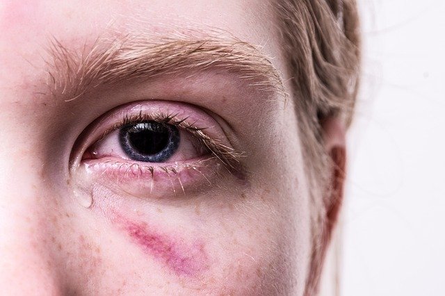 If the eyes become dry, they will burn, sting, and tear. Why Do My Tears Burn My Face The Unseen Problems And Their Solutions