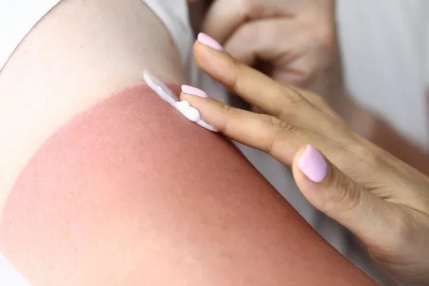 Cocoa butter for sunburn