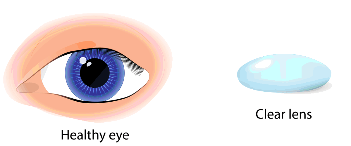 Cataract Procedures Frankfort Eye Center