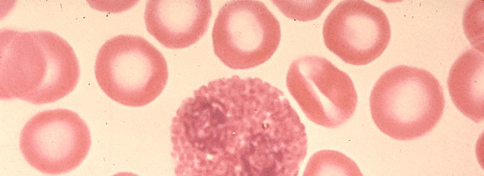 Eosinófilos altos (eosinofilia) causas y tratamiento natural
