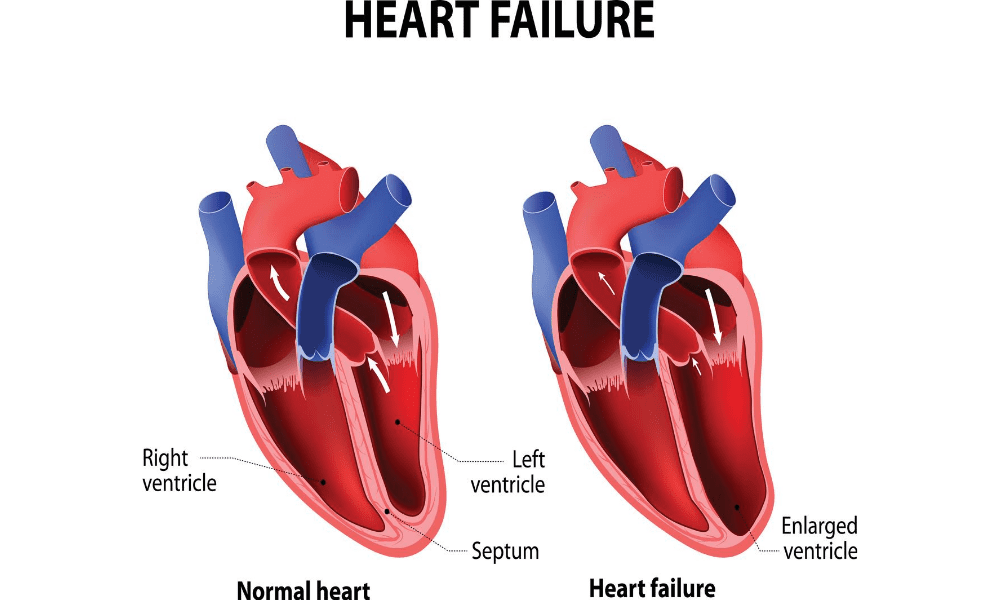 Heart Failure - Are you at risk?