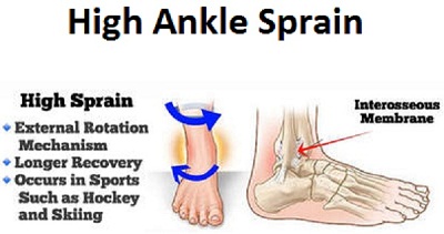 picture High Ankle Sprain Recovery Time health guideline