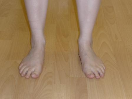 Flat Feet