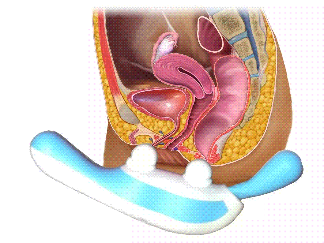 Diagram of the broader pelvic floor position