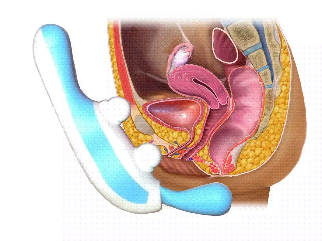 Diagram of the upper pelvic position with vibration