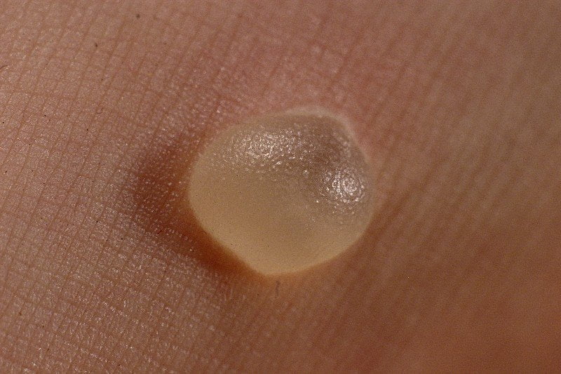 White blister with black dot at roger bond blog