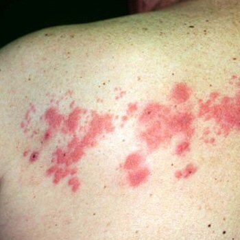 Shingles - shingles disease Shingles - shingles disease
