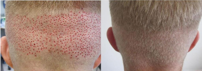 With fut, transplantation of hair in naturally occurring individual follicular units was established.5 in these methods, donor harvesting was done by single . NeoGraft FUE hair transplant - NeoGraft, An Automated FUE